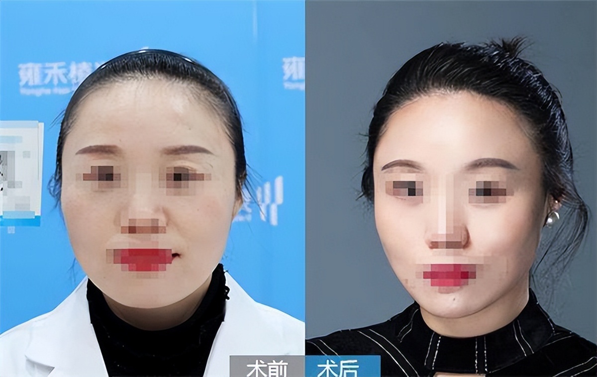 植发真的有用吗现在很多植发医院,效果最好的植发方法