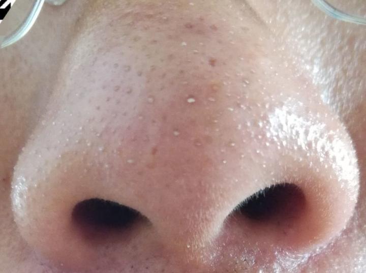 黑头没挤干净怎么办,黑头没及时处理变成黑痣了怎么办