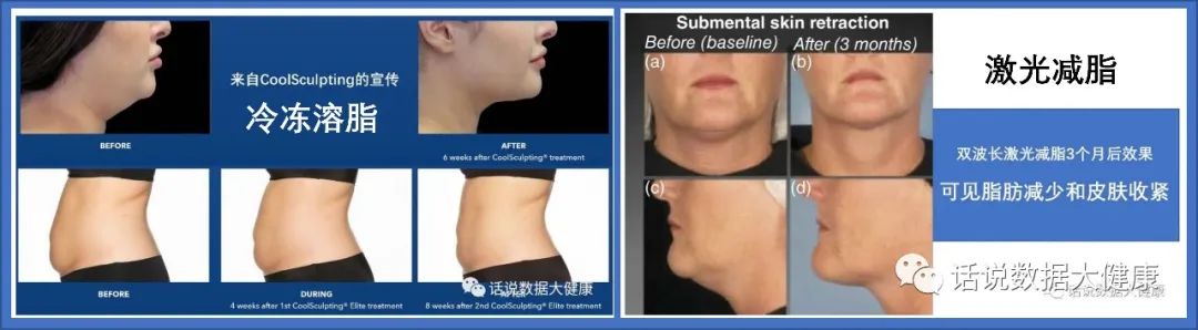 超声减脂注意事项,激光减脂和射频减脂的区别