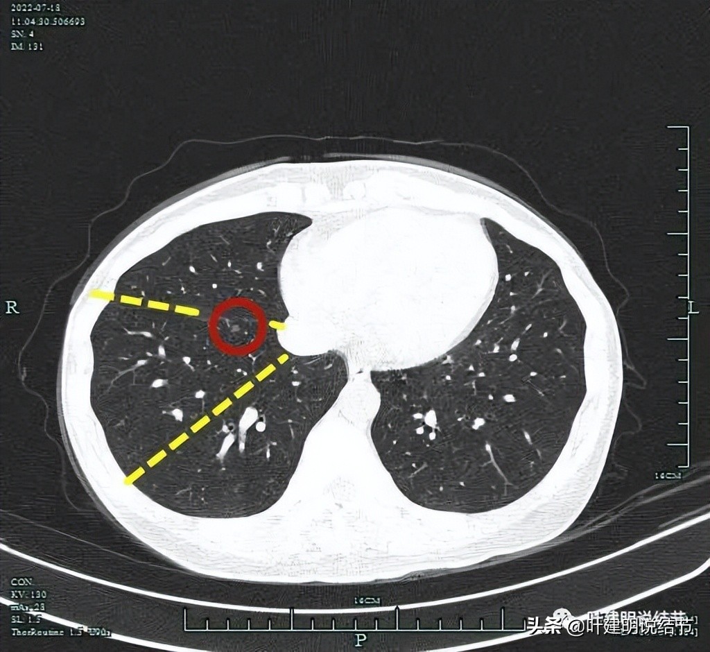 2cm的肺磨玻璃结节如何处理最合适,年轻女人磨玻璃结节