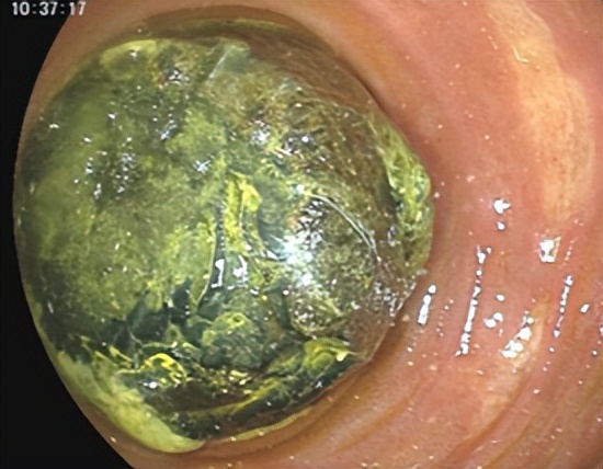 哈医大一院群力院区能体外碎石吗,哈医大一院激光科