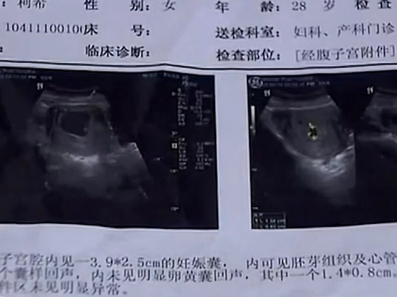 15年武汉女子打胎救白血病弟弟,武汉女子为救弟弟打掉腹中双胞胎