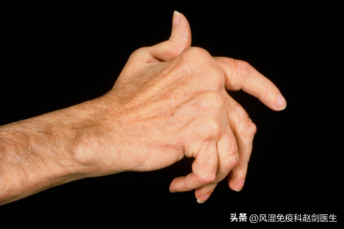 类风湿性关节炎用什么激素好,类风湿关节炎必须用活血药吗