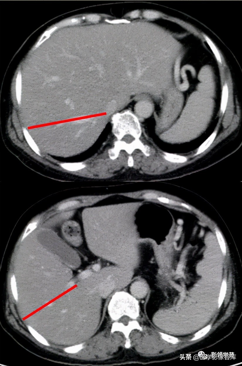 肝脏影像分叶分段解剖图,肝脏分段解剖图谱