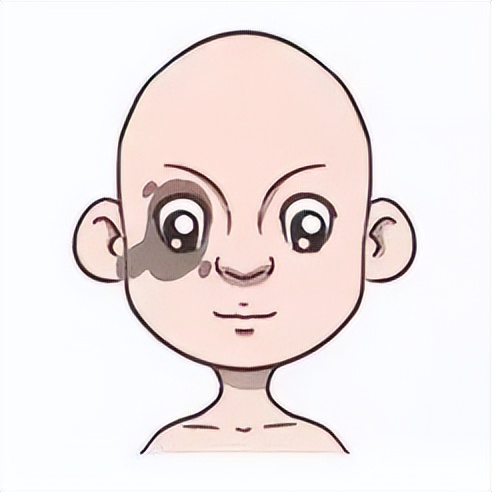 新生儿有胎记,新生儿身上有胎记怎么处理