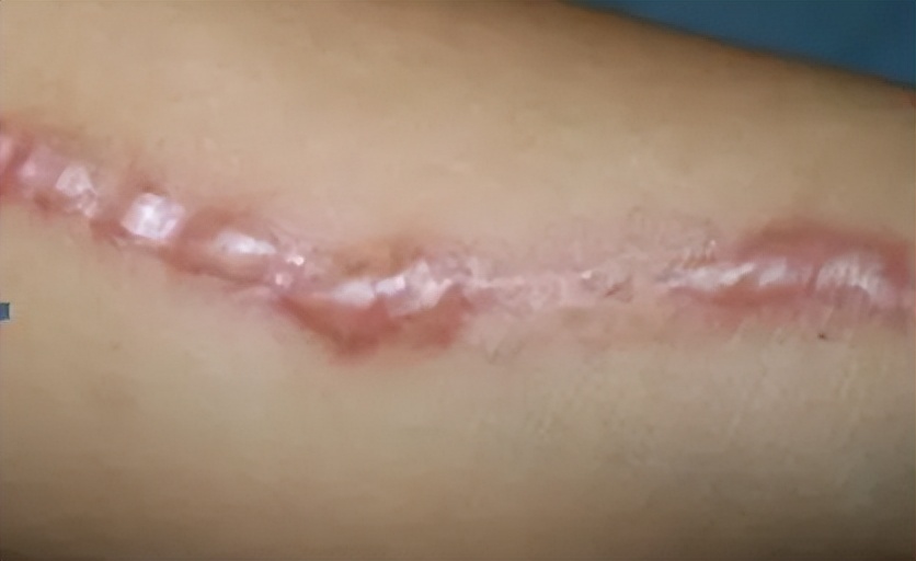 增生性疤痕能慢慢变淡吗,增生性疤痕一直在长怎么办