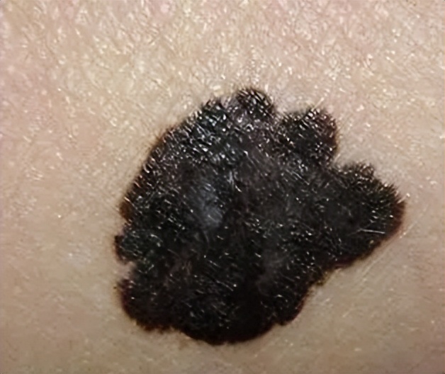 脚后跟长鸡眼严重性,脚后跟有个三四年的鸡眼