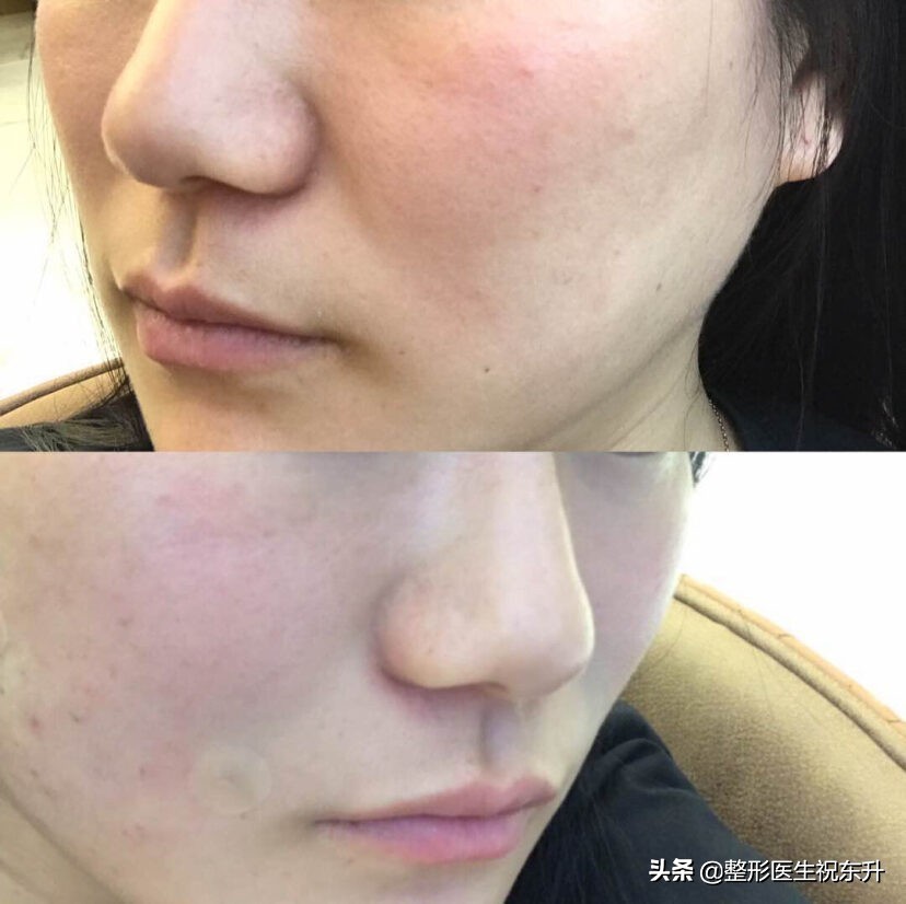 脸上有法令纹用什么办法把它消掉,法令纹和木偶纹的消除方法