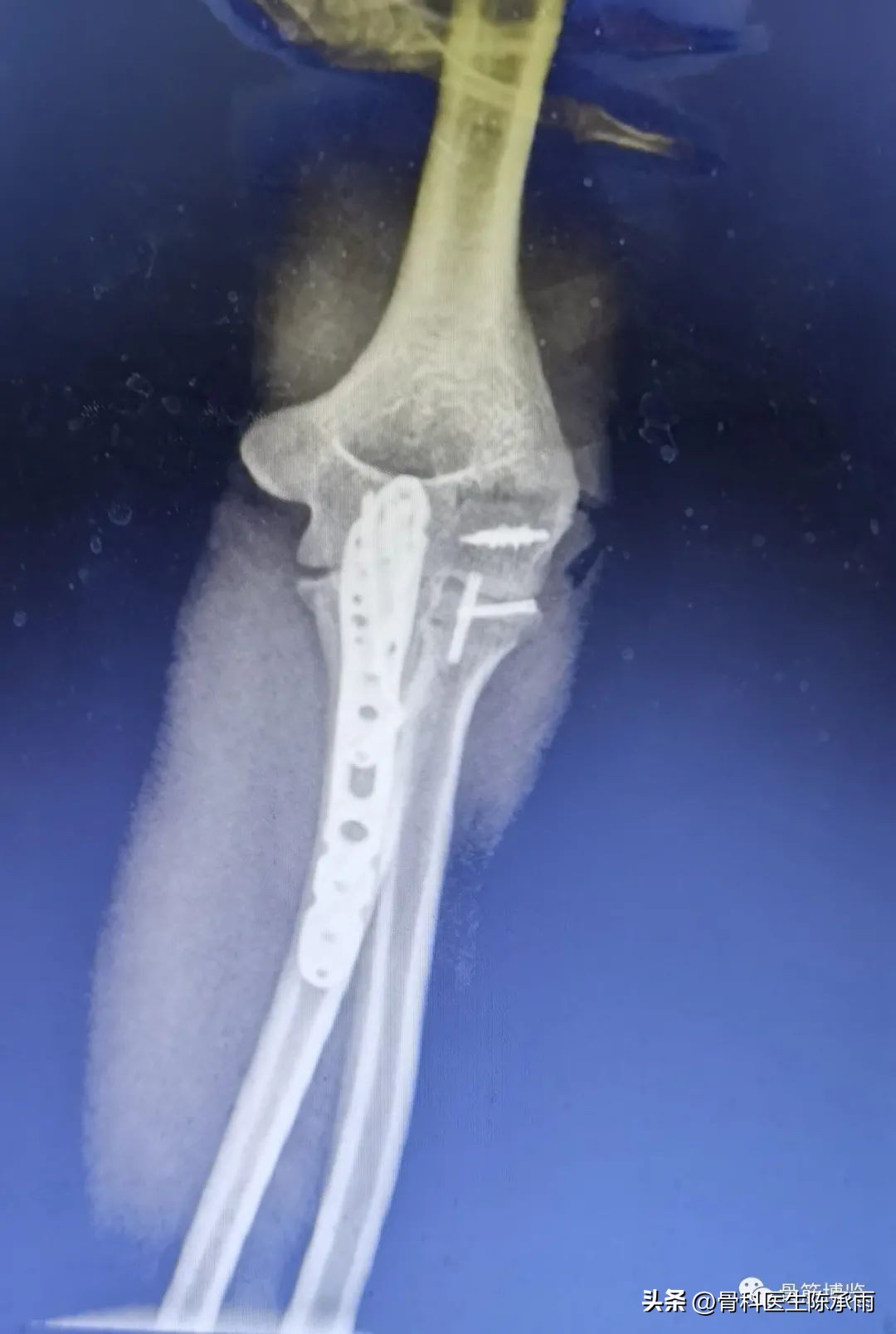 肘关节恐怖三联征最新治疗方法,肘关节恐怖三联征最佳治疗方法