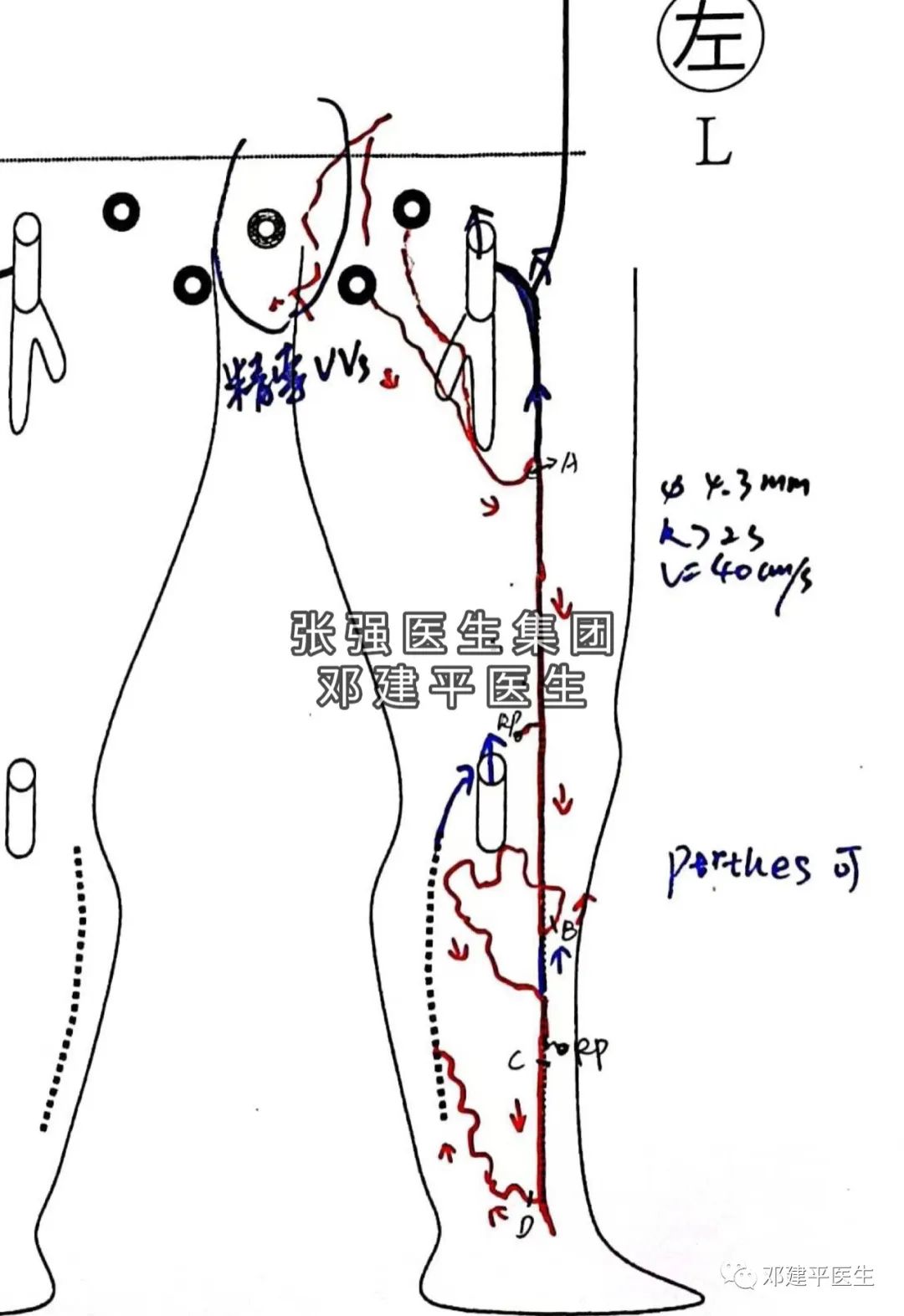 下肢静脉曲张非手术治疗护理,下肢静脉曲张2级吃药可以消除吗