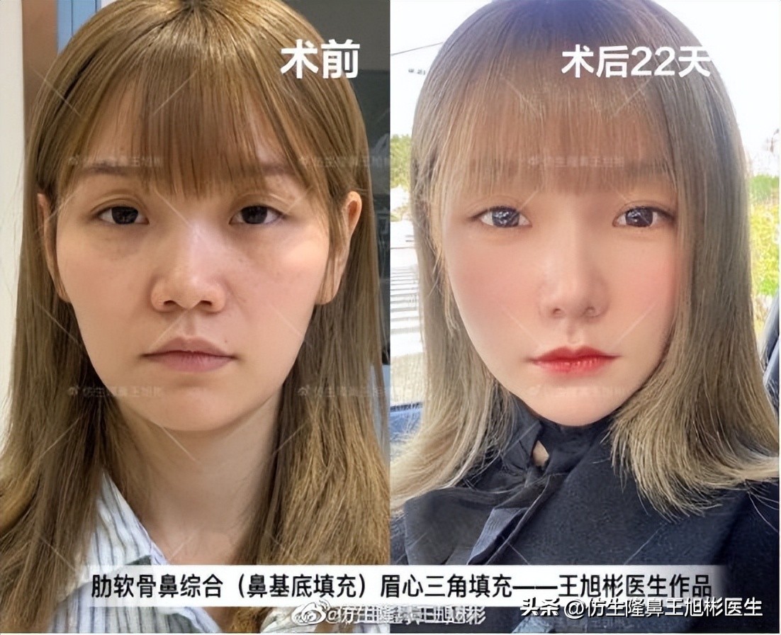 鼻翼缩小可以改善鼻翼缘后缩吗,鼻翼肥大如何正确改善