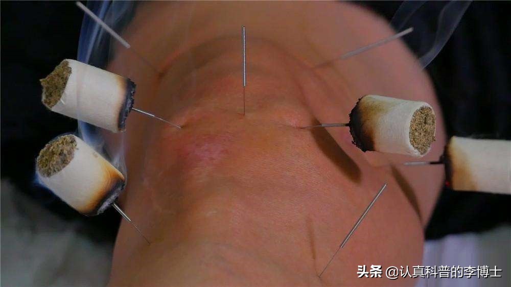 关节有积液需要抽吗,抽关节积液有什么危害