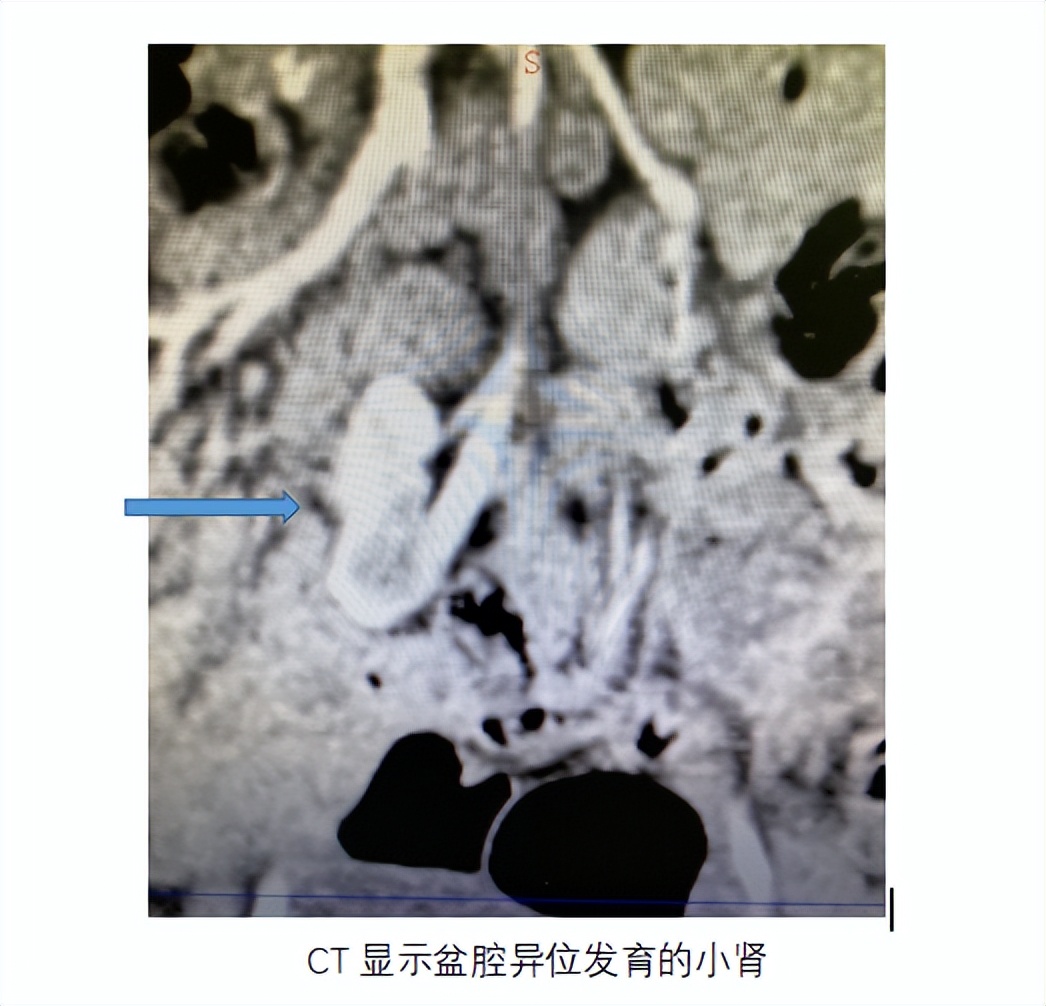 异位肾最佳治疗方法,异位肾要做手术吗