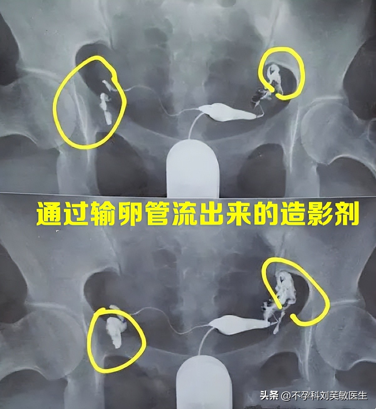 输卵管造影步骤图片解读,如何看懂输卵管造影片子