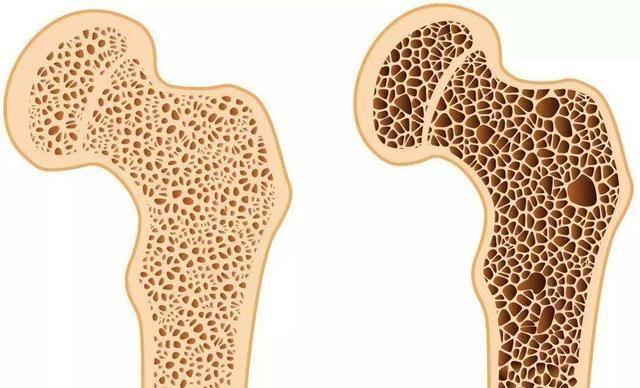 治疗骨质疏松的药品,中草药治疗骨质疏松