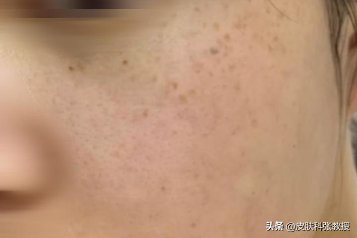 10岁女孩脸上长斑点怎么治,13岁男生脸上长褐色斑怎么治