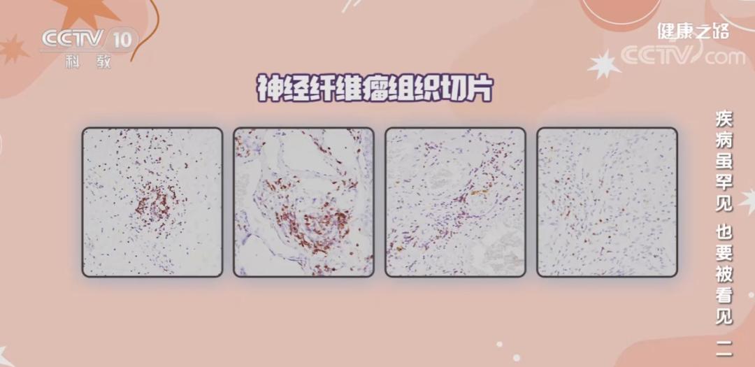 cctv干细胞治疗视频,cctv-10科教频道免疫力