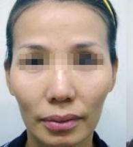 颧骨突出外扩图片,左侧颧骨外扩凸出