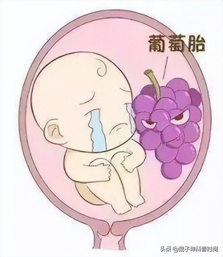 孕早期大量出血是流产了吗,孕早期少量出血肯定是流产吗