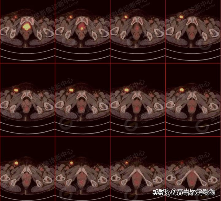 罕见卵巢恶性肿瘤,肿瘤罕见病