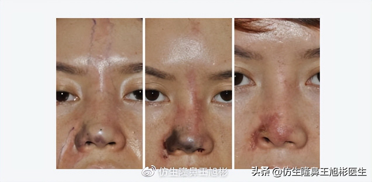 鼻整形最简易方法,鼻孔又大又塌又朝天鼻整形