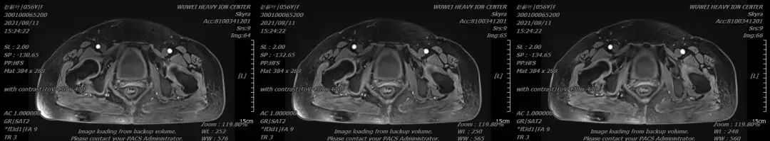 重离子治疗肿瘤效果怎么样,重离子治疗卵巢癌症