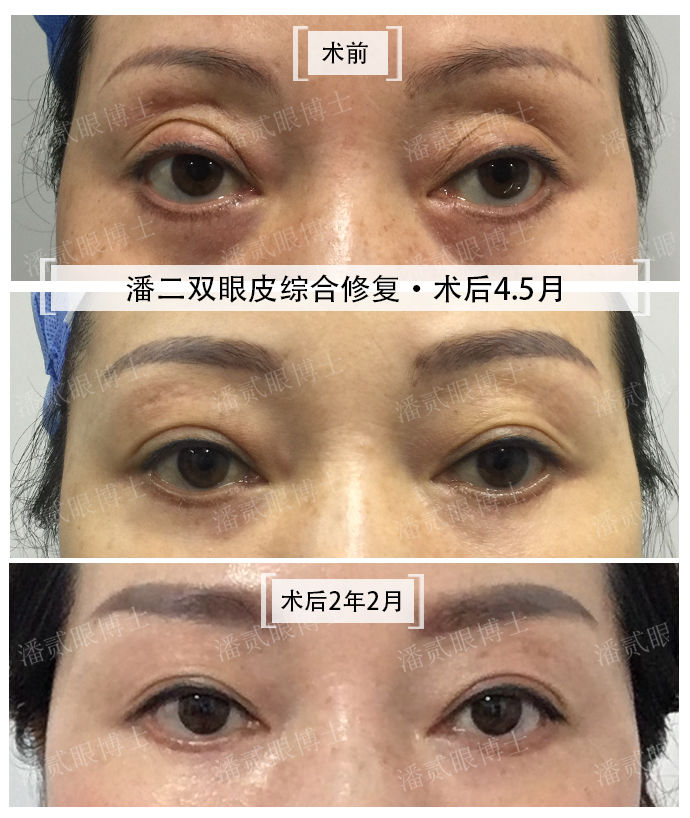 凸眼球显得眼睛大,凸眼眼窝凹陷