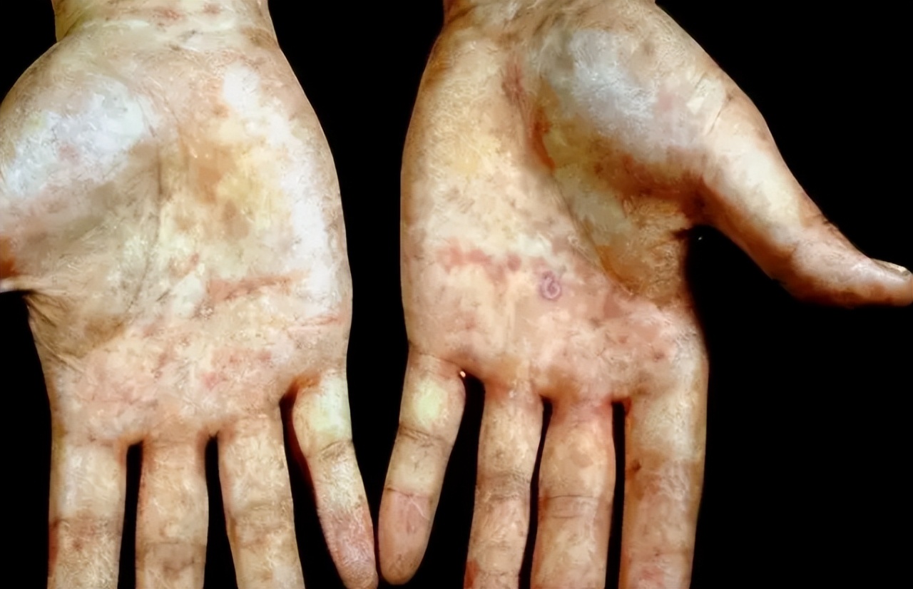 艾滋病的口腔症状有哪些？不妨查看自己是否有这3个“迹象”