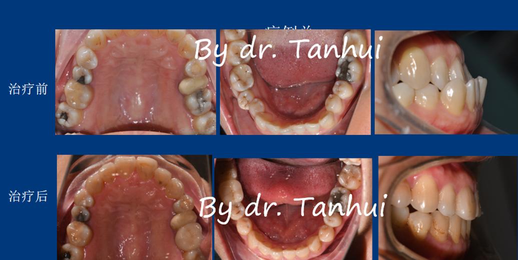 地包天能做手术矫正吗,儿童地包天矫正几岁做最好