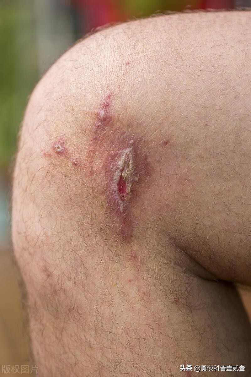 隐翅虫咬后皮肤感染,隐翅虫咬伤后皮肤溃烂了怎么办