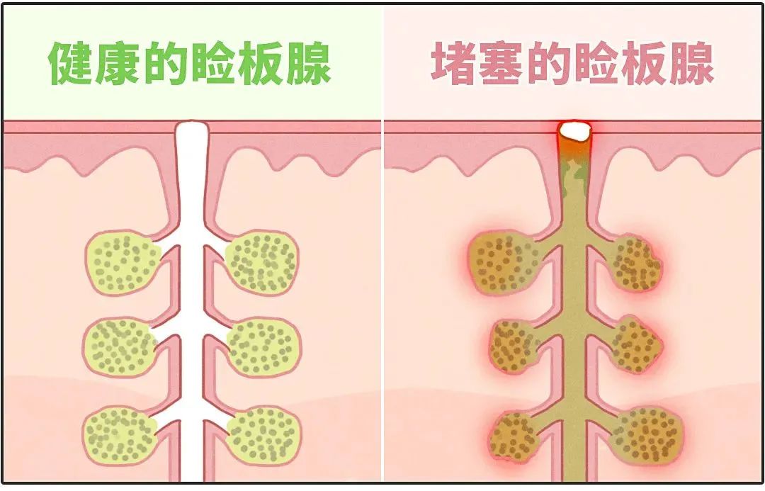 眼睛干涩缓解眼疲劳的眼药水,眼干涩吃什么药能缓解眼疲劳