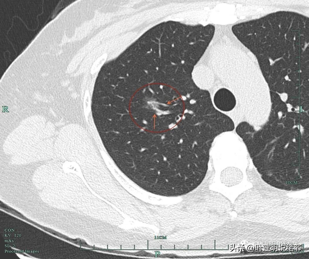 浙江肿瘤医院做肺结节手术多少钱,浙江省肿瘤医院肺结节微创手术
