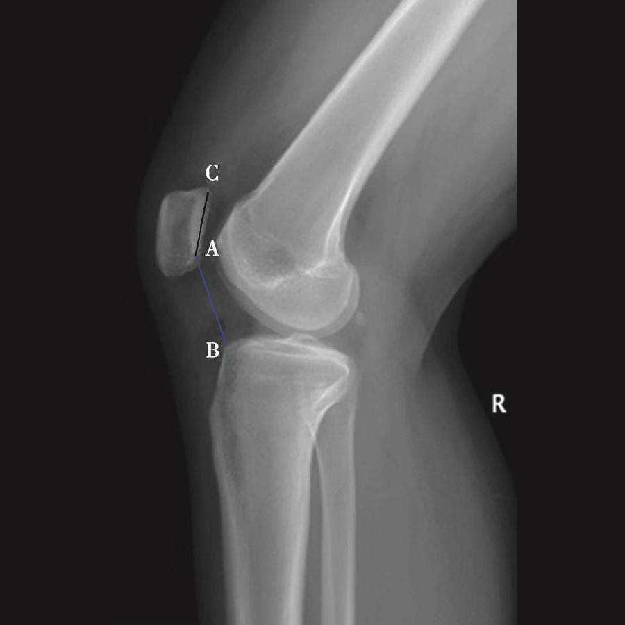 髌骨骨折评估,髌骨上下滑动评估什么内容