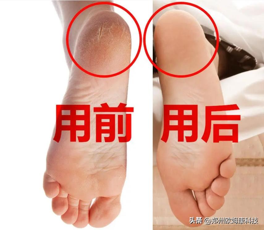 脚后跟干裂修复硅胶袜,脚后跟干裂起硬皮防裂袜