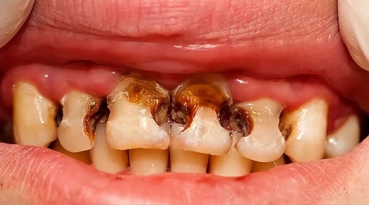 什么样的可乐牙需要治疗,健康科普温馨提示信息