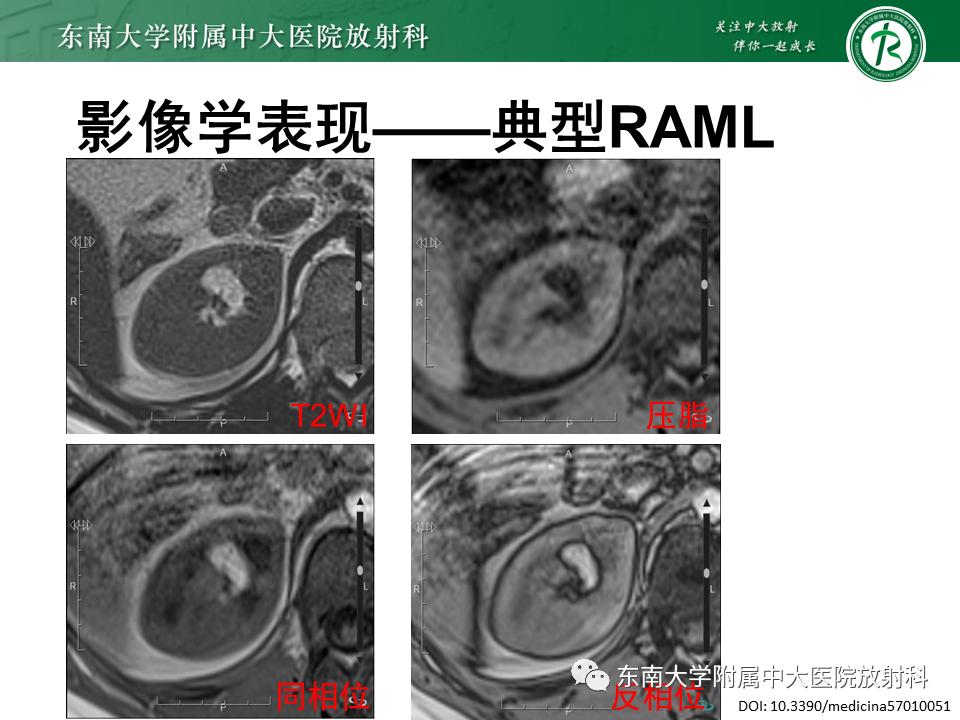 好文分享——《肾血管平滑肌脂肪瘤》