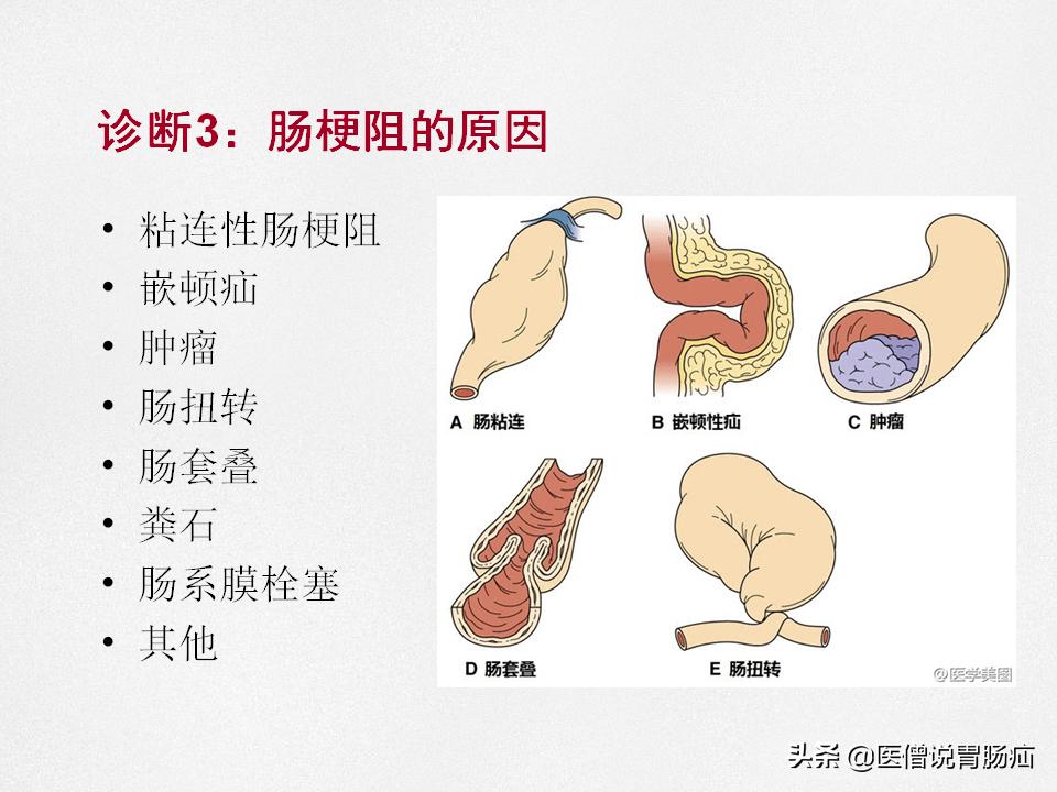 肠梗阻健康教育,肠梗阻患者的健康宣教