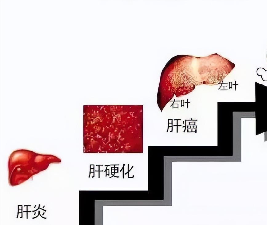 慢性乙肝治疗多久才能转阴,慢性乙肝什么时候能转阴彻底治愈