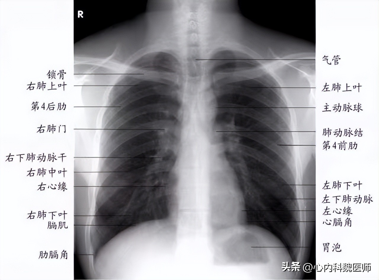 肺纹理增多会造成什么情况,ct检查肺纹理增多增粗是什么意思