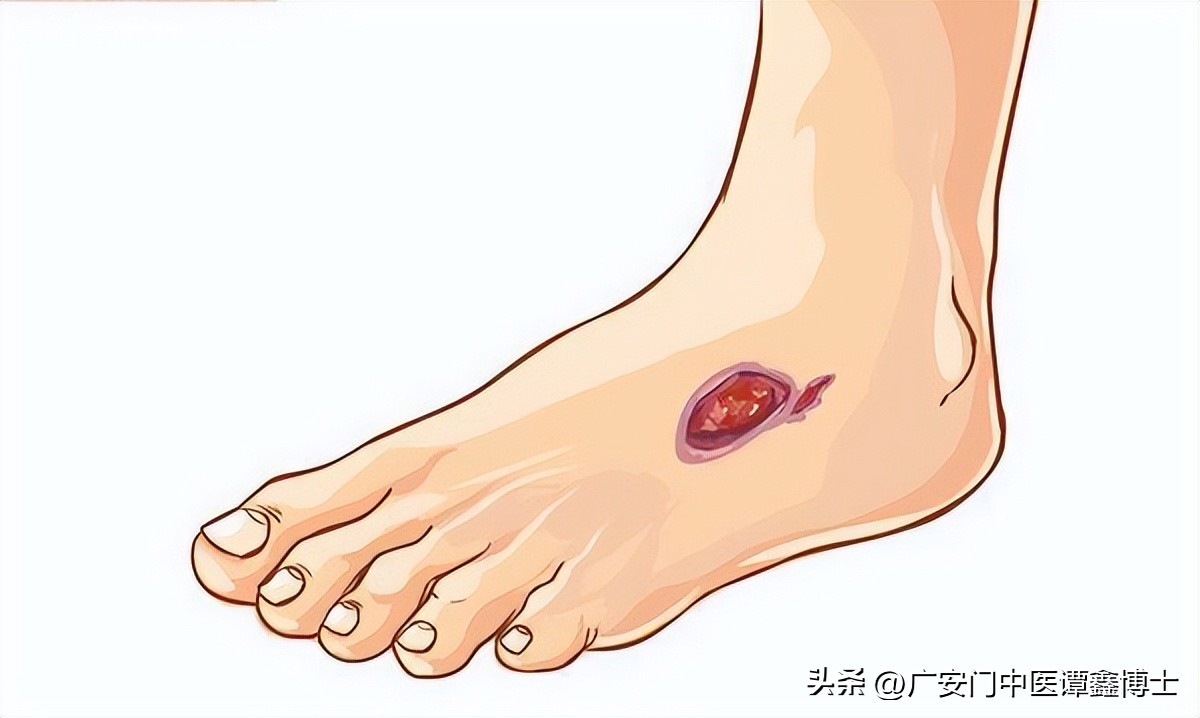 肺癌患者脸色黑皮肤有溃烂怎么办,肺癌晚期全身皮肤变黄什么原因