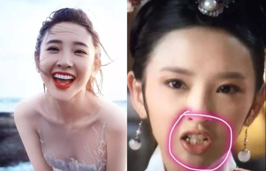 明星做烤瓷牙变凸嘴,明星烤瓷牙凸嘴