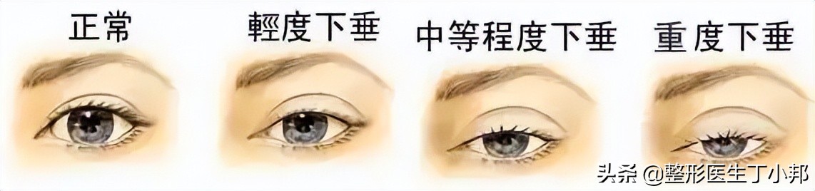 眼周年轻化有什么好的解决方法,眼周年轻化的治疗方法有哪些