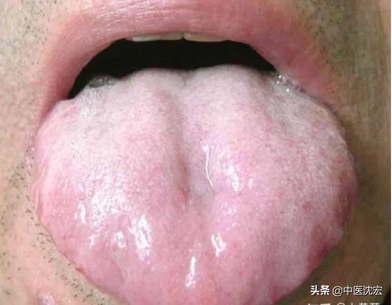 气虚自汗吃玉屏风散有用吗,头脸爱出汗吃玉屏风散有用吗