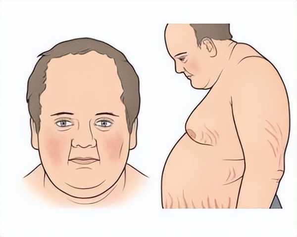 有祛除肥胖纹的真实案例吗,隐形肥胖怎么消除
