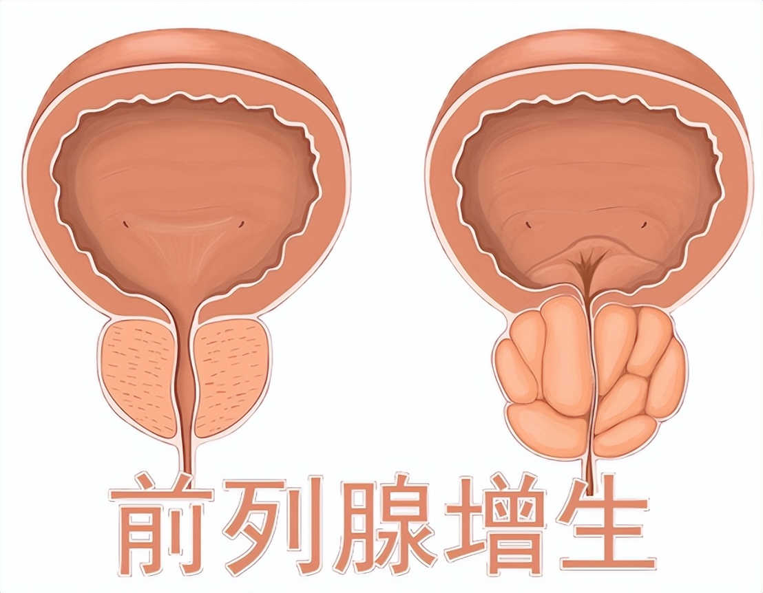 他达拉非治前列腺增生有效果吗,他达拉非5毫克可以修复血管吗