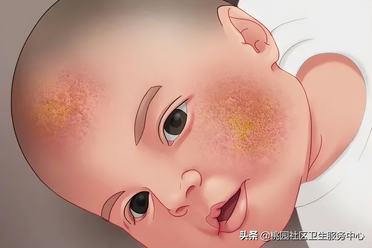 湿疹咳嗽是怎么回事,儿童咳嗽湿疹适合喝什么汤