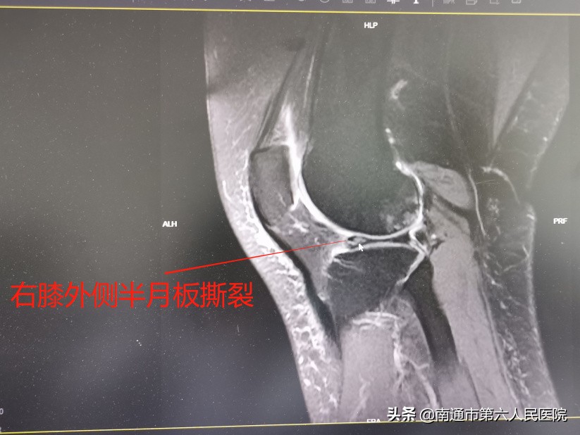 半月板撕裂修复成形手术利弊,半月板前角撕裂缝合恢复