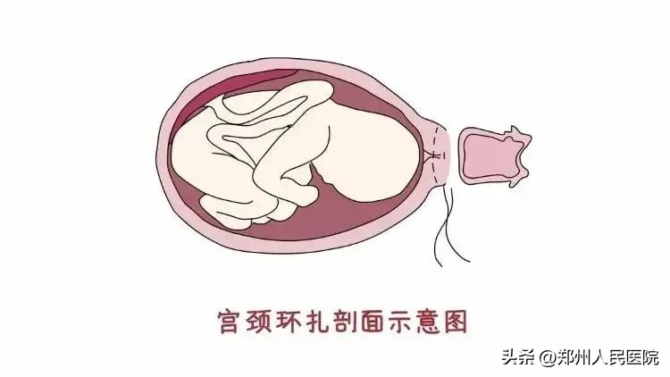 孕21周凶险性前置胎盘反复出血,凶险性前置胎盘28周早产