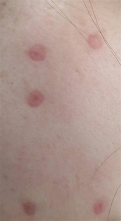 脸上的痣可以点掉吗,脸上有痣激光去痣好还是药水点好