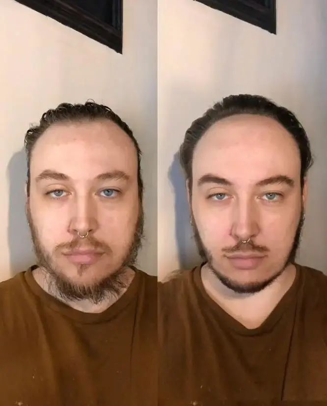 发际线后移遗传吗,发际线后移怎么办适合什么发型